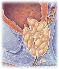 Prostate Gland Enlargement Treatment